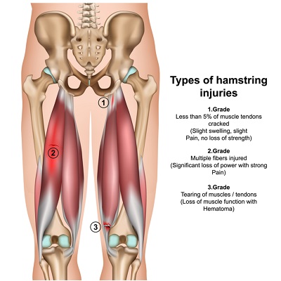 Sporting Injuries Brisbane